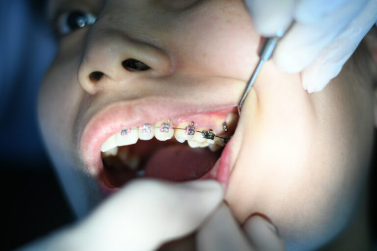 Anvisa proíbe fita dental 9D por riscos à saúde